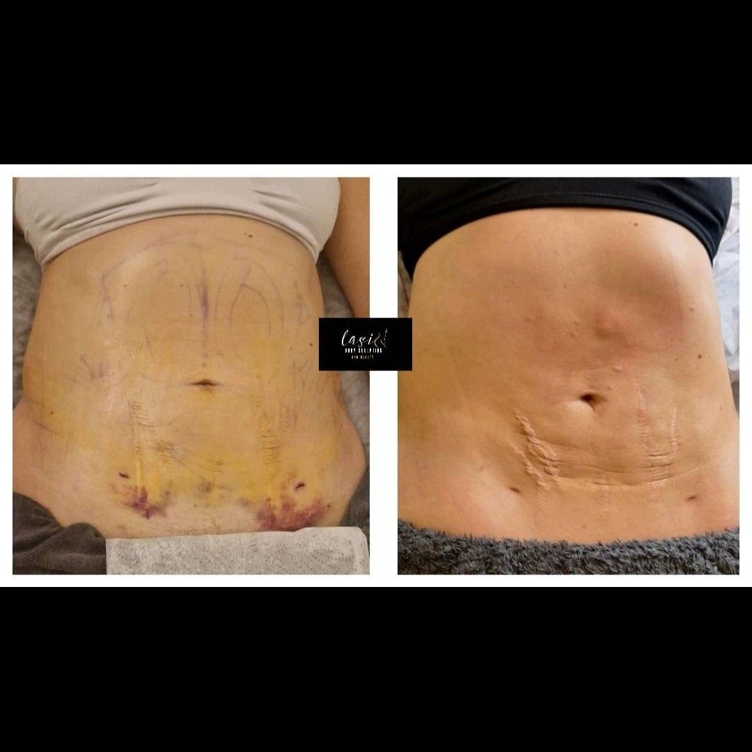 post lymphatic-drainage treatment